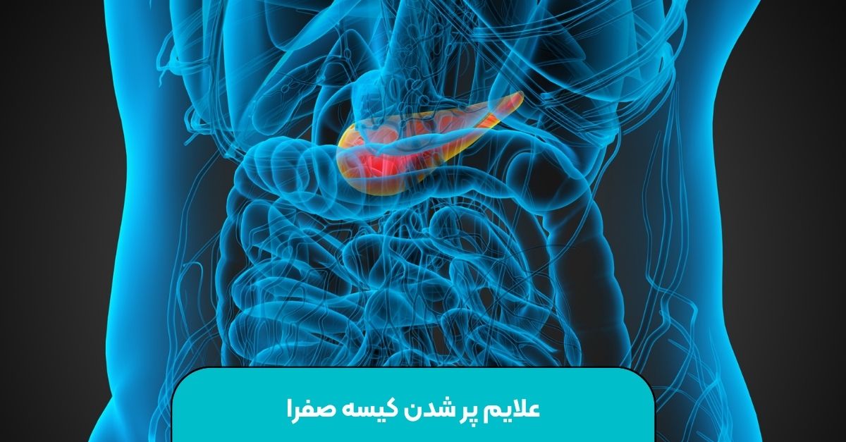 علایم پر شدن کیسه صفرا
