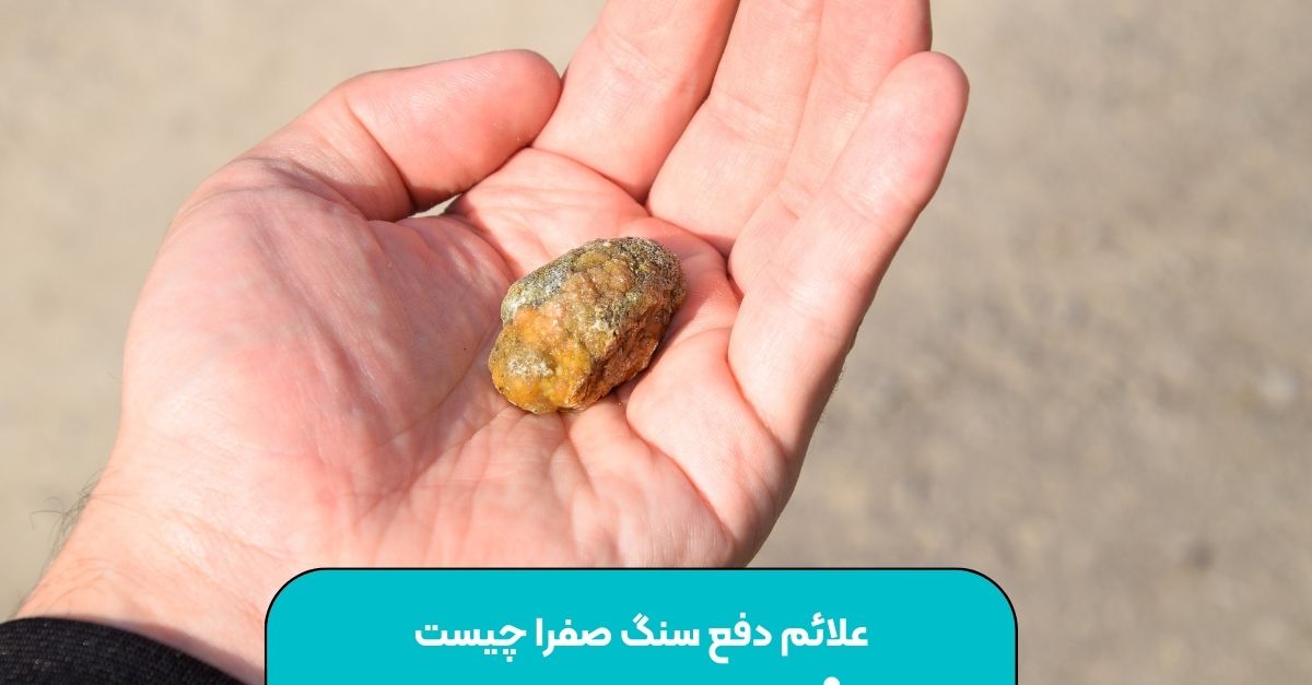 علائم دفع سنگ صفرا چیست