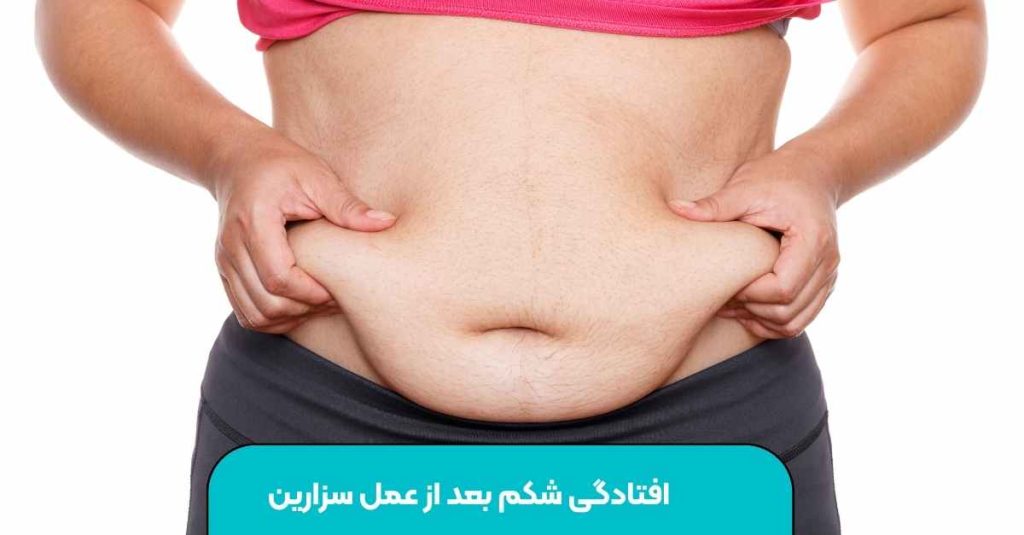 افتادگی شکم بعد از عمل سزارین