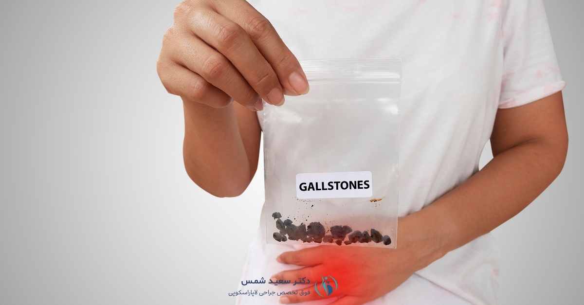 لاغری بعد از سنگ کیسه صفرا