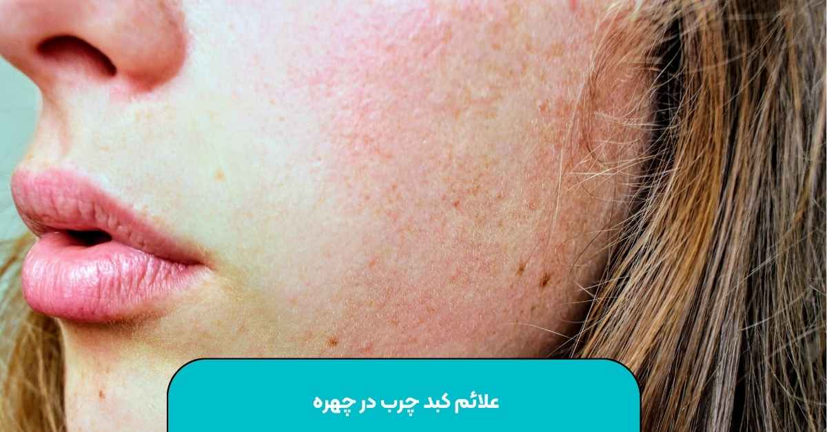 علائم کبد چرب در چهره