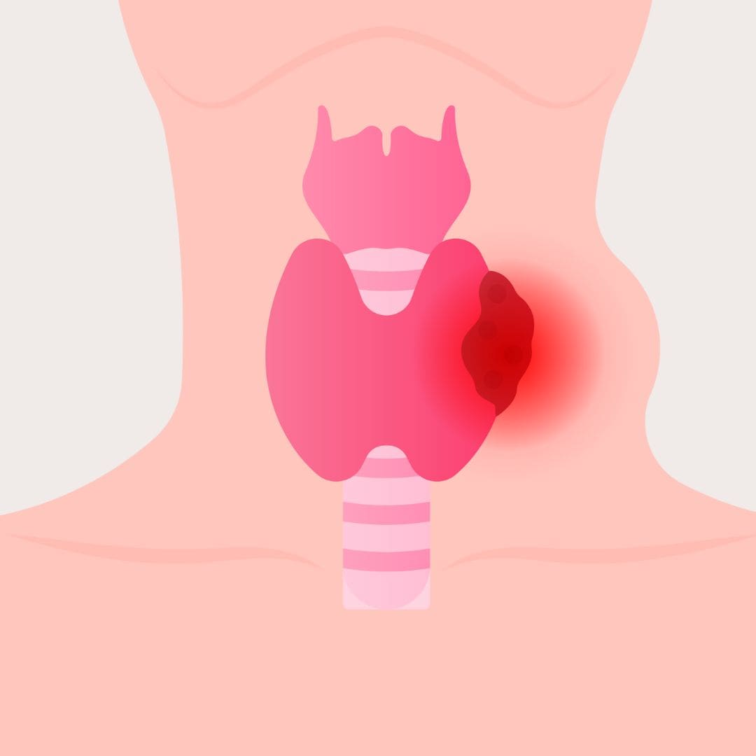 جراحی ندولهای تیروئید