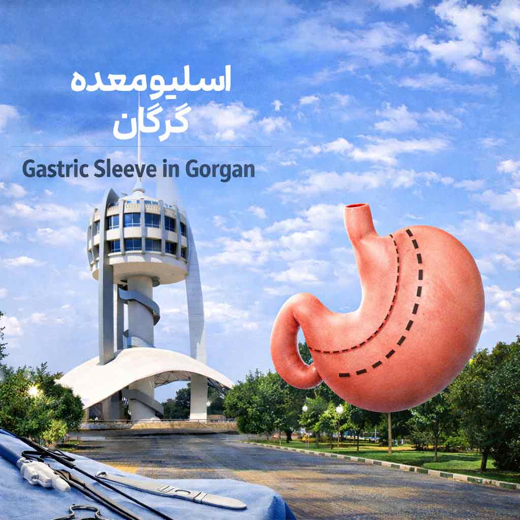 دکتر اسلیو معده در گرگان