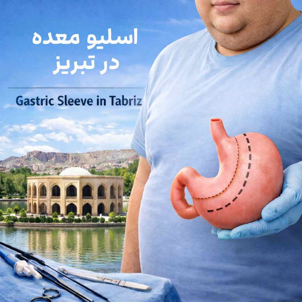 اسلیو معده در تبریز