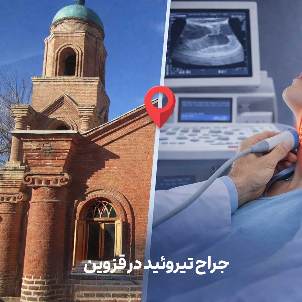 جراح تیروئید در قزوین