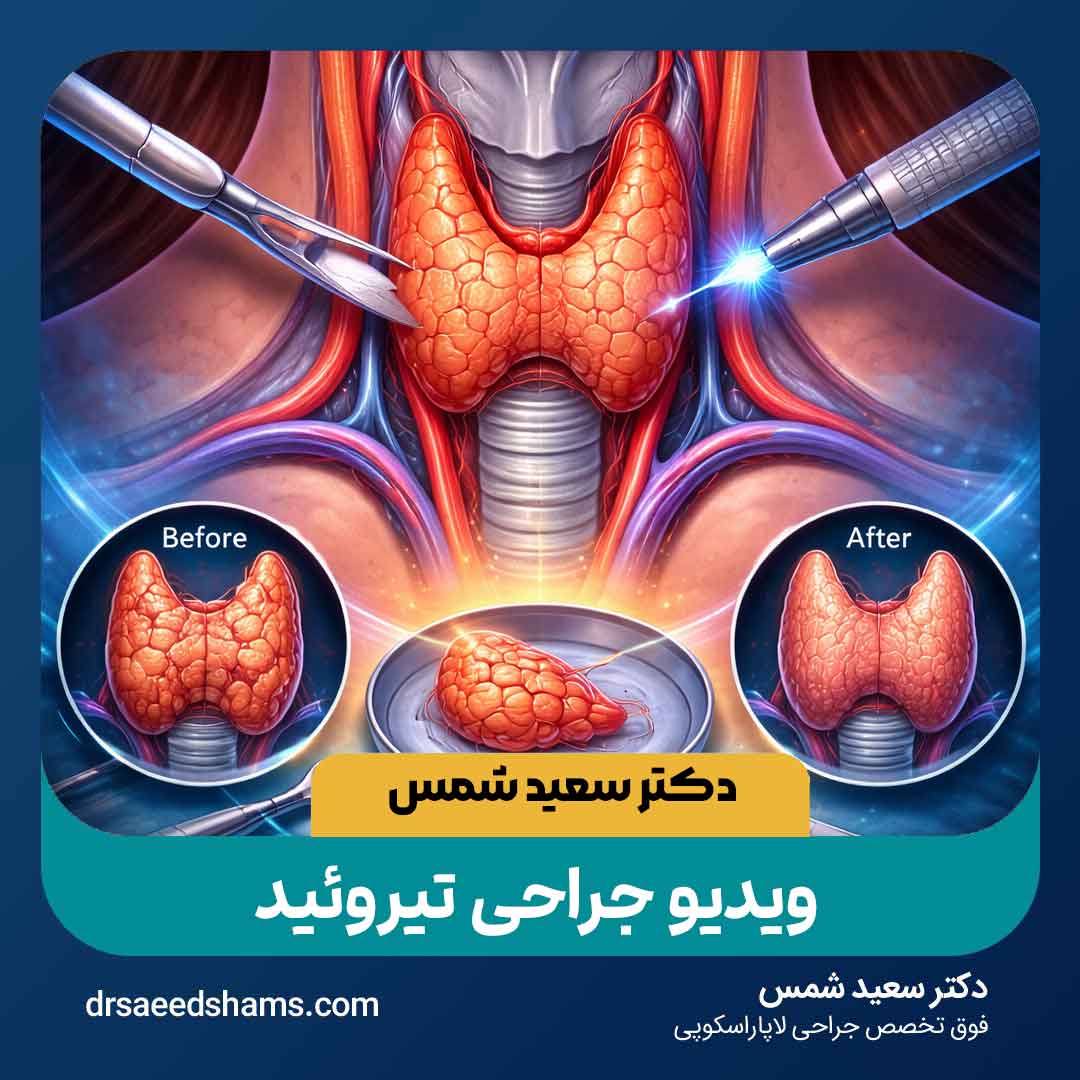 کاور ویدیو جراحی تیروئید