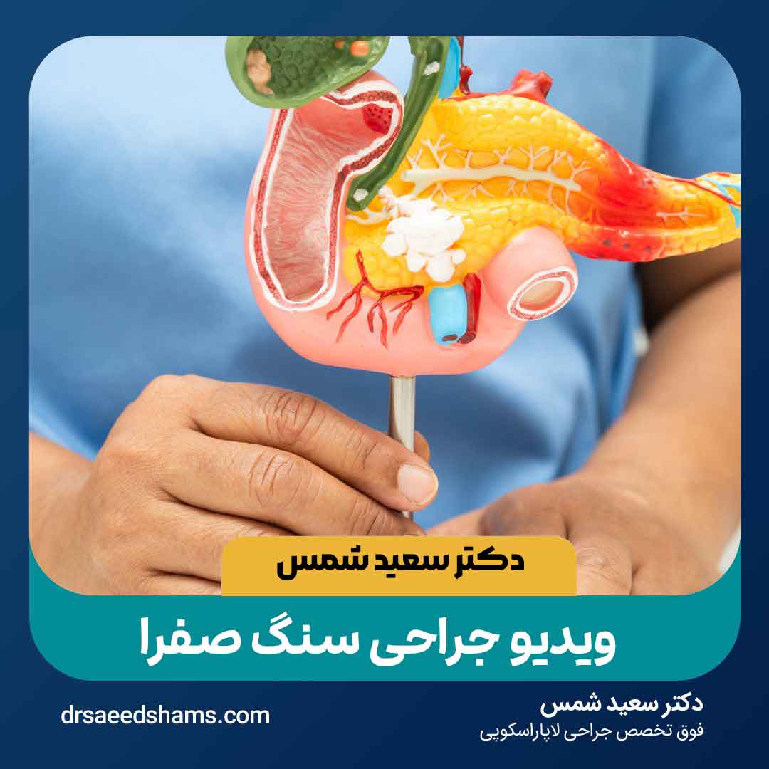 نحوه جراحی سنگ صفرا