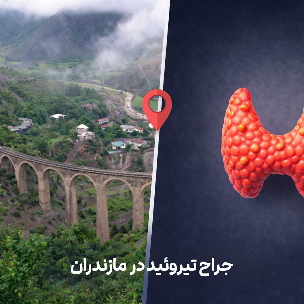 جراح تیروسید در مازندران