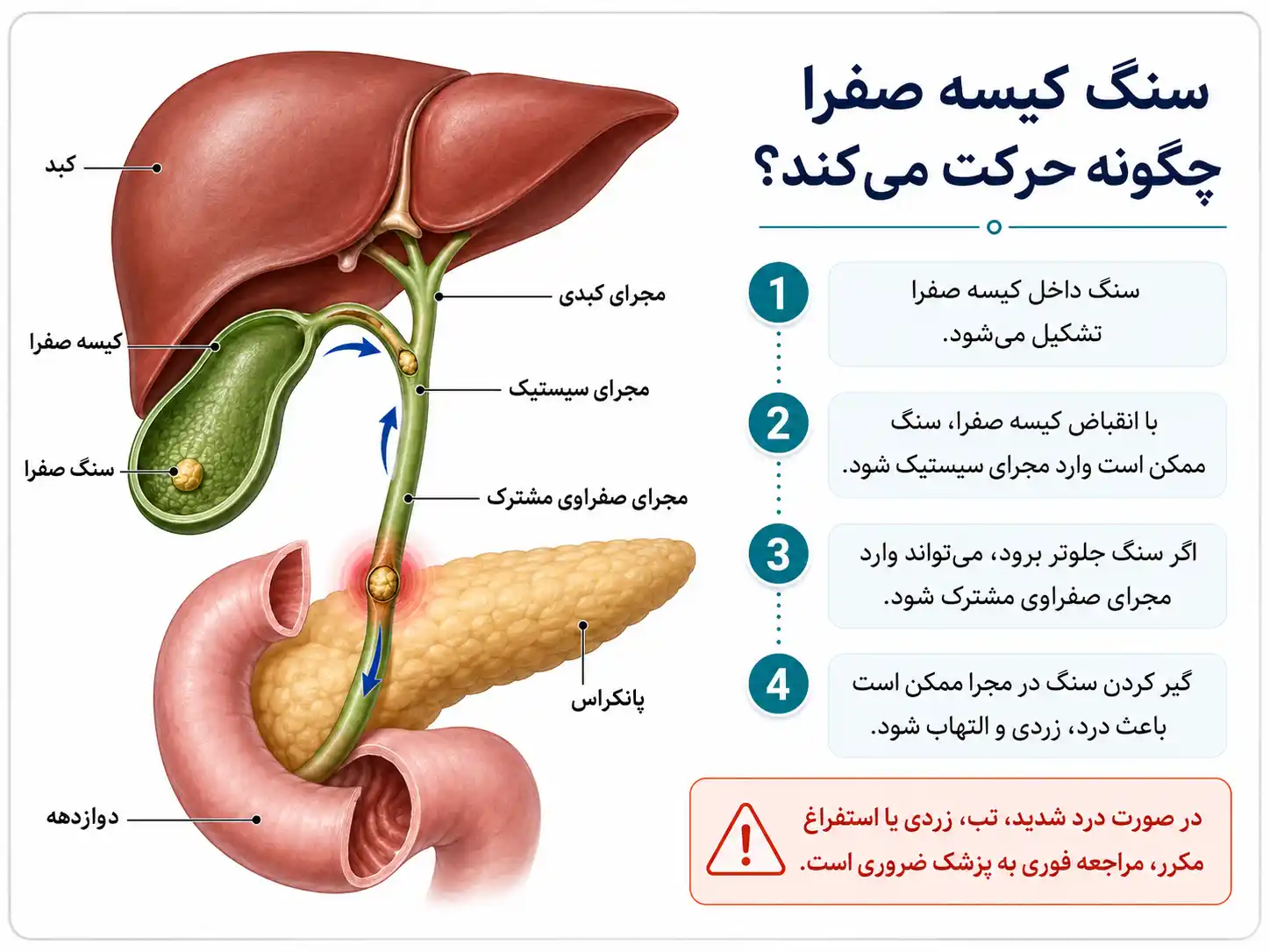 سنگ کیسه صفرا چگونه حرکت میکند؟