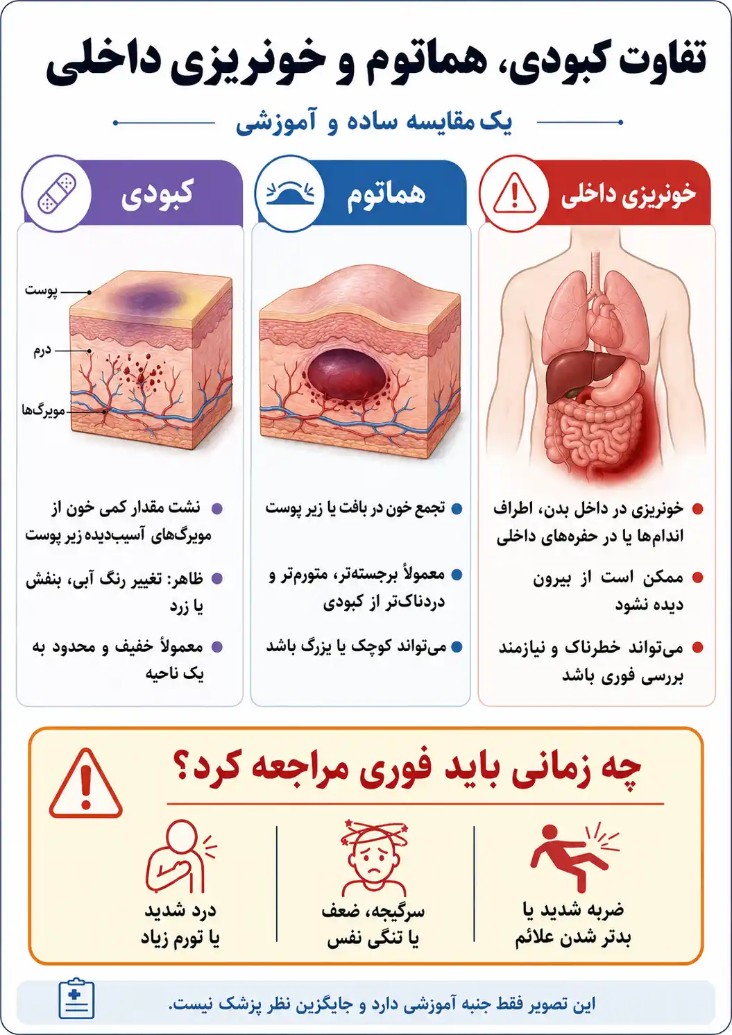 تفاوت کبودی، هماتوم و خونریزی داخلی