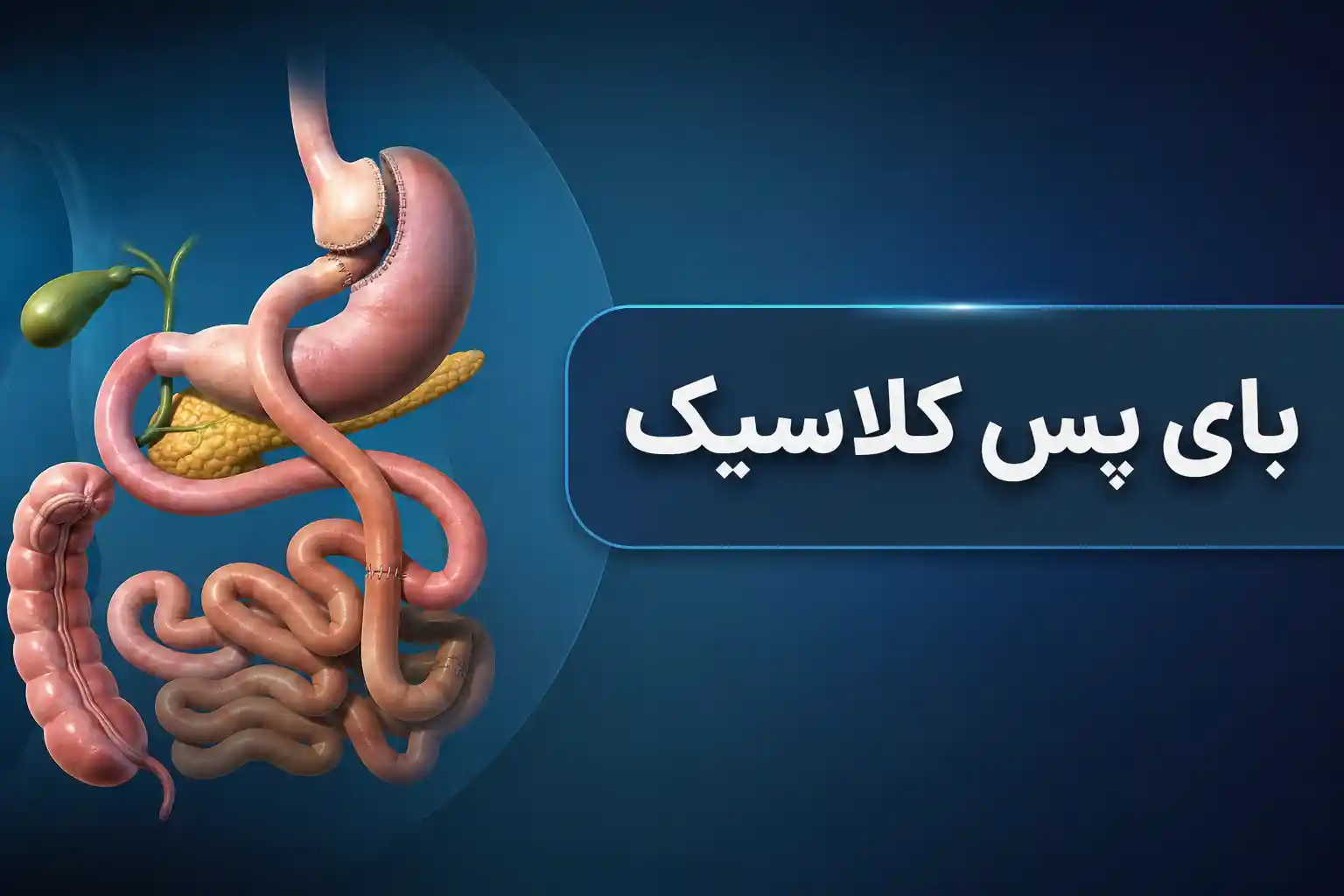 بایپس معده کلاسیک