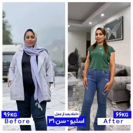 30 کیلو کاهش وزن پس از اسلیو معده