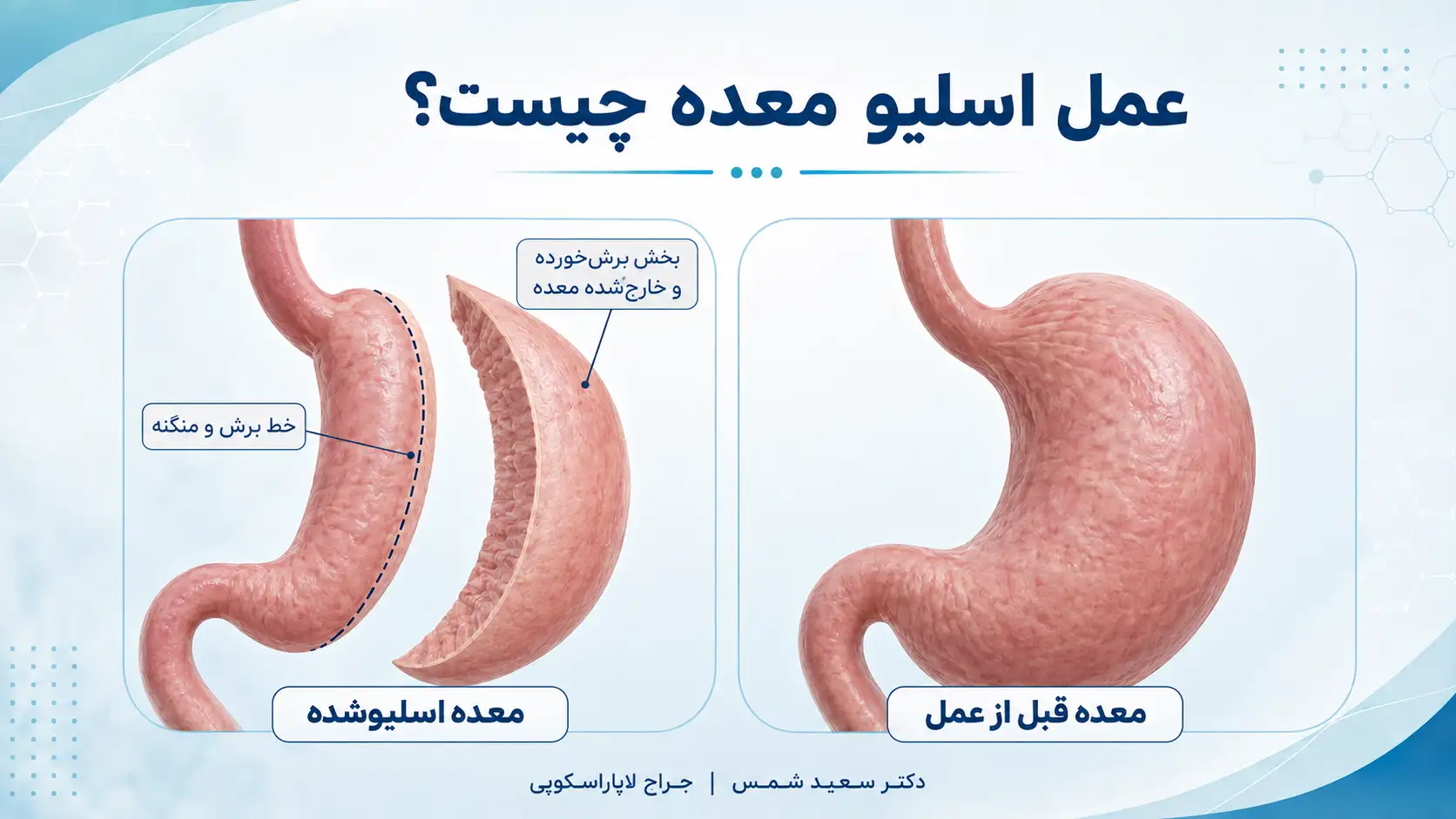 عمل اسلیو معده